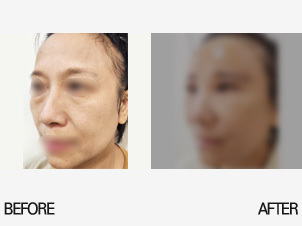 상안검+눈및지방재배치+얼굴지방이식+실리프팅 1일 후
